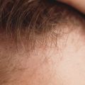 ハゲ(脱毛症)治療に光明か、研究者が「ハゲるかどうか」に関与するタンパク質を特定